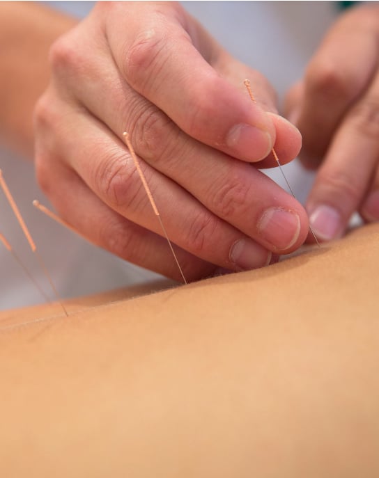 Akupunktur